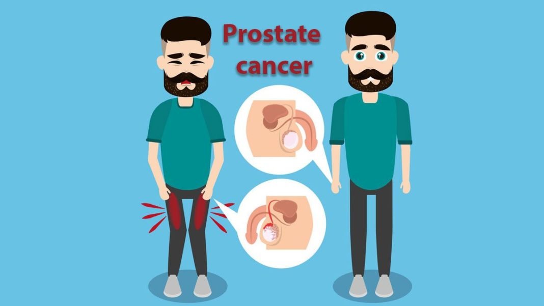 Prostate Cancer, Trend Health
