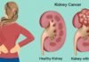 Kidney Cancer Symptoms, trend health