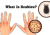 What Is Scabies?, Trend Health