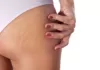 Reducing Stretch Marks, Trend Health