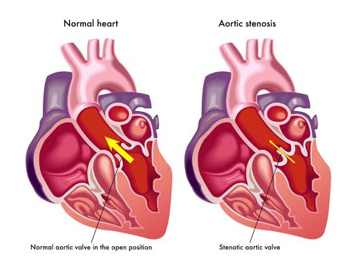 Aortic Valve Stenosis, Trend Health