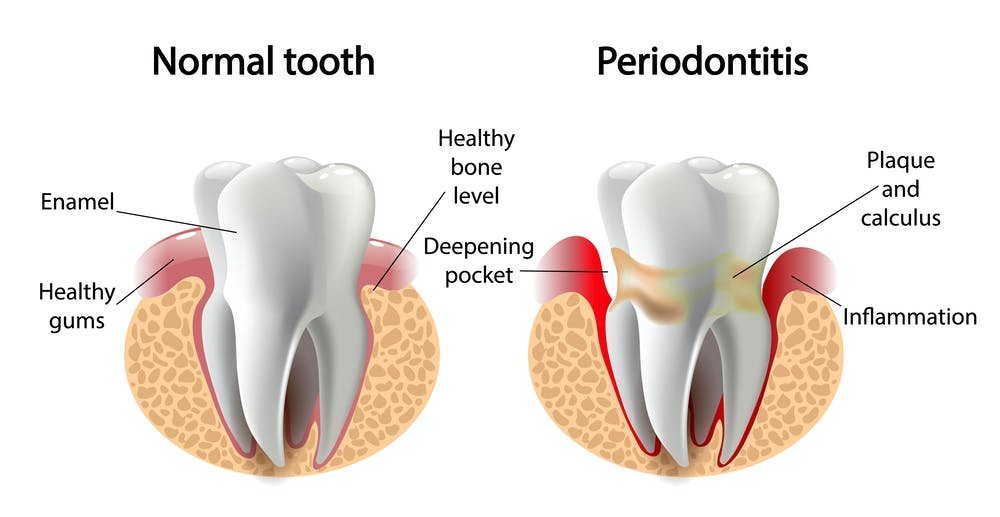 What is Periodontitis?, Trend Health