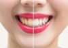 Yellow Teeth, Trend Health