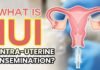 IUI Treatment