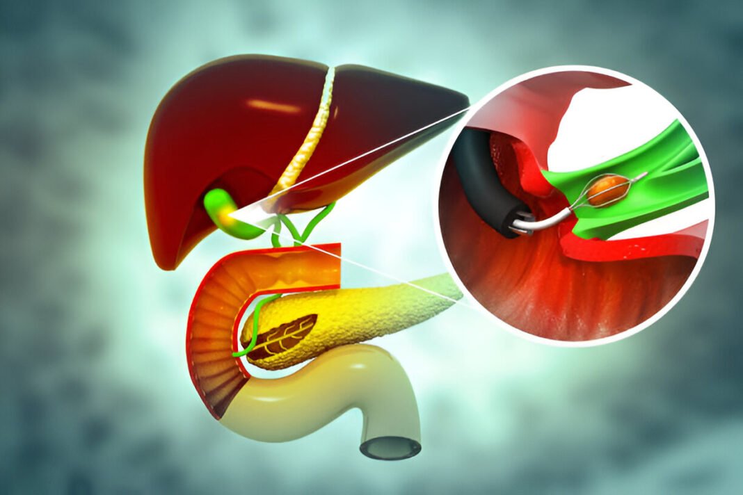 Gallstones (Cholelithiasis)