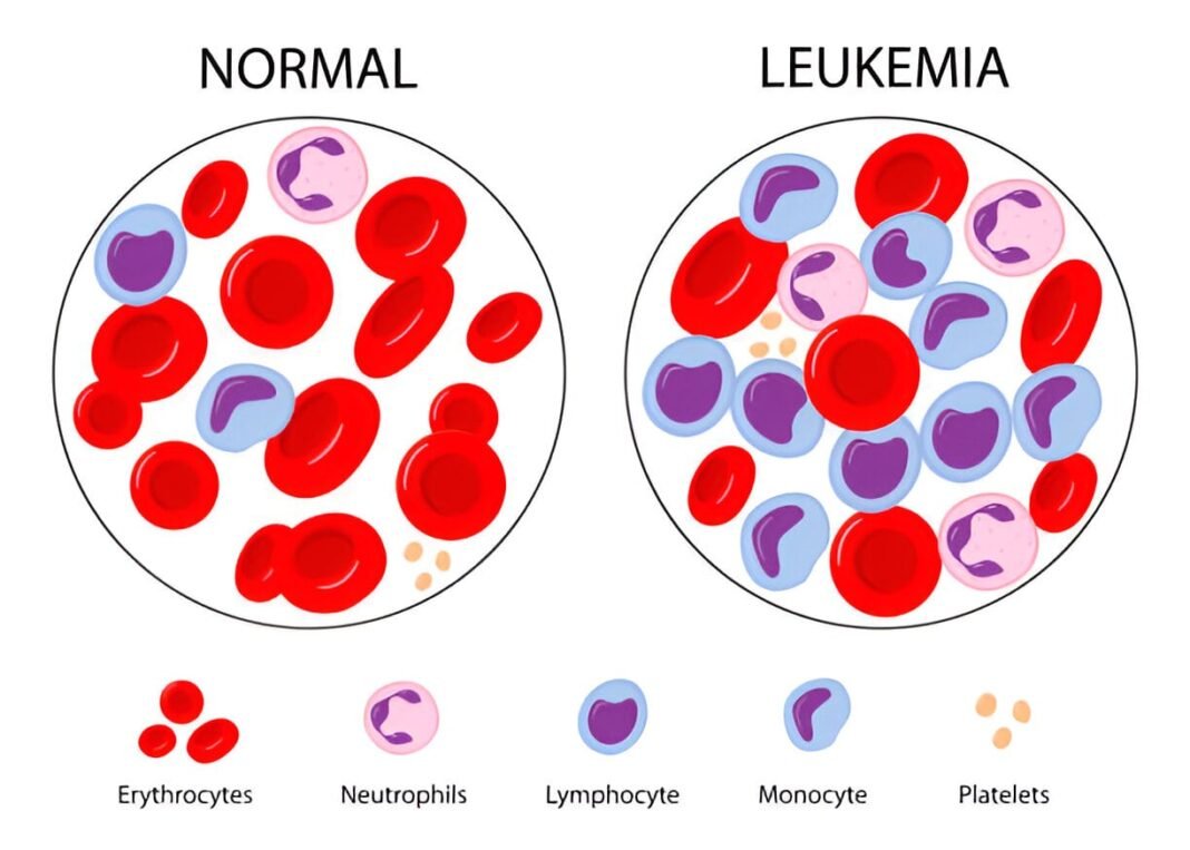 Leukemia (Blood Cancer) Symptoms, Causes & Treatment